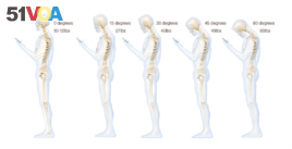 This chart shows the stress put on the neck and spine as a result of hunching over a smartphone (Courtesy Dr. Ken Hansraj M.D.)
