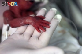 FILE - A nurse holds the hand of a premature baby, who was born at five months of pregnancy, at a hospital in Medellin, Colombia, Aug. 2014.