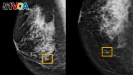 A yellow box indicates where an artificial intelligence (AI) system found cancer hiding inside breast tissue, in an undated photo released by Northwestern University in Chicago, Jan. 1, 2020. 