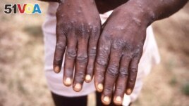 This 1997 image provided by the CDC during an investigation into an outbreak of m<I><I>onkey</I></i>pox, which took place in the Democratic Republic of the Congo (DRC), formerly Zaire, and depicts the dorsal surfaces of the hands of a m<i><I>onkey</I></i>pox case patient.