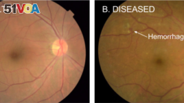 Google deep learning methods are used to detect diabetic eye disease. The image on the left is a healthy retina, while the one on the right shows signs of diabetic disease. (Google AI)