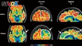 These PET scan images provided by the New England Journal of Medicine in January 2024 show a reduction in amyloid-beta levels in an Alzheimer's patient after focused ultrasound treatment to open the blood-brain barrier after 26 weeks. (New England Journal of Medicine via AP)