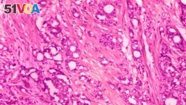 This 1974 microscope image made available by the Centers for Disease Control and Prevention shows changes in cells indicative of adenocarcinoma of the prostate. 