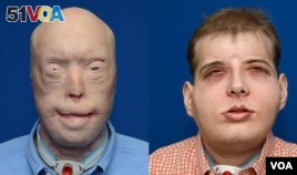 A firefighter gets new face in the most extensive face transplant in history. (VOA FILE PHOTO)