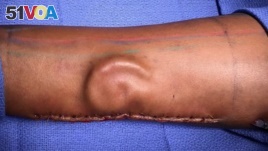 Cartilage in the shape of an ear growing in a patient's forearm is shown as part of cutting-edge total ear reconstruction. (Photo Credit: U.S. Army photo ) 