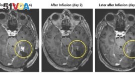 This combination of MRI scan images provided by the New England Journal of Medicine in March 2024 shows the progress of a glioblastoma patient who received CAR-T therapy which uses modified versions of T cells from a patient's own immune system. (NEJM via AP)