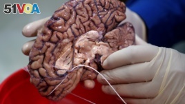 A doctor holds a human brain in a brain bank in the Bronx borough of New York City, New York, U.S. June 28, 2017. REUTERS/Carlo Allegri