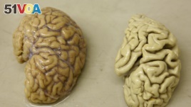 One hemisphere of a healthy brain (L) is pictured next to one hemisphere of a brain of a person suffering from Alzheimer disease. (FILE PHOTO)