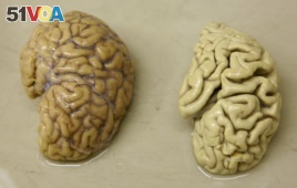 One hemisphere of a healthy brain (L) is pictured next to one hemisphere of a brain of a person suffering from Alzheimer disease.