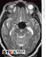 A magnetic resonance image of a brain that has suffered a huge aneurysm: the black spot in the center of the picture
