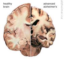 A drawing of a healthy brain, left, and a brain with Alzheimer's, right. 