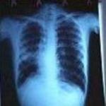 Tens of Millions of TB Patients Cured