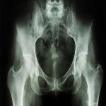 Osteoporosis Increases Danger of Broken Bones