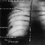 An x-ray of Theodore Roosevelt's rib showing the bullet shot by John Schrank