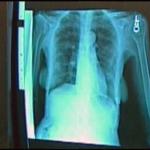 Study: Early CT Scans Increase Lung Cancer Survival Rates