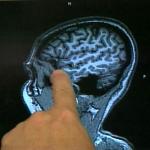 MRI-like Scan May Help Identify Alzheimer's